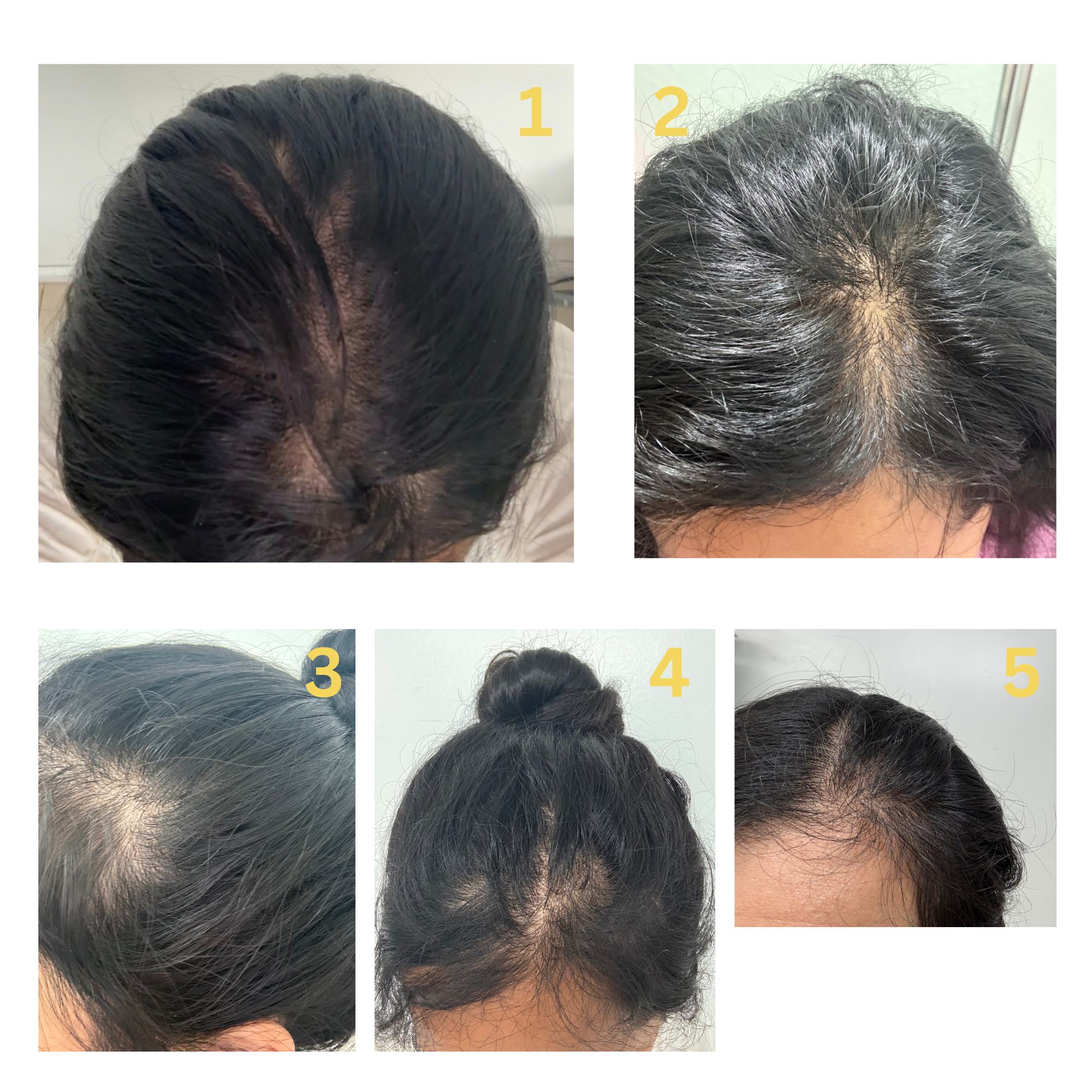 Step-by-step derma stamp tutorial-disinfecting, parting hair, positioning, stamping the scalp, wait time before applying oil, and cleaning the tool