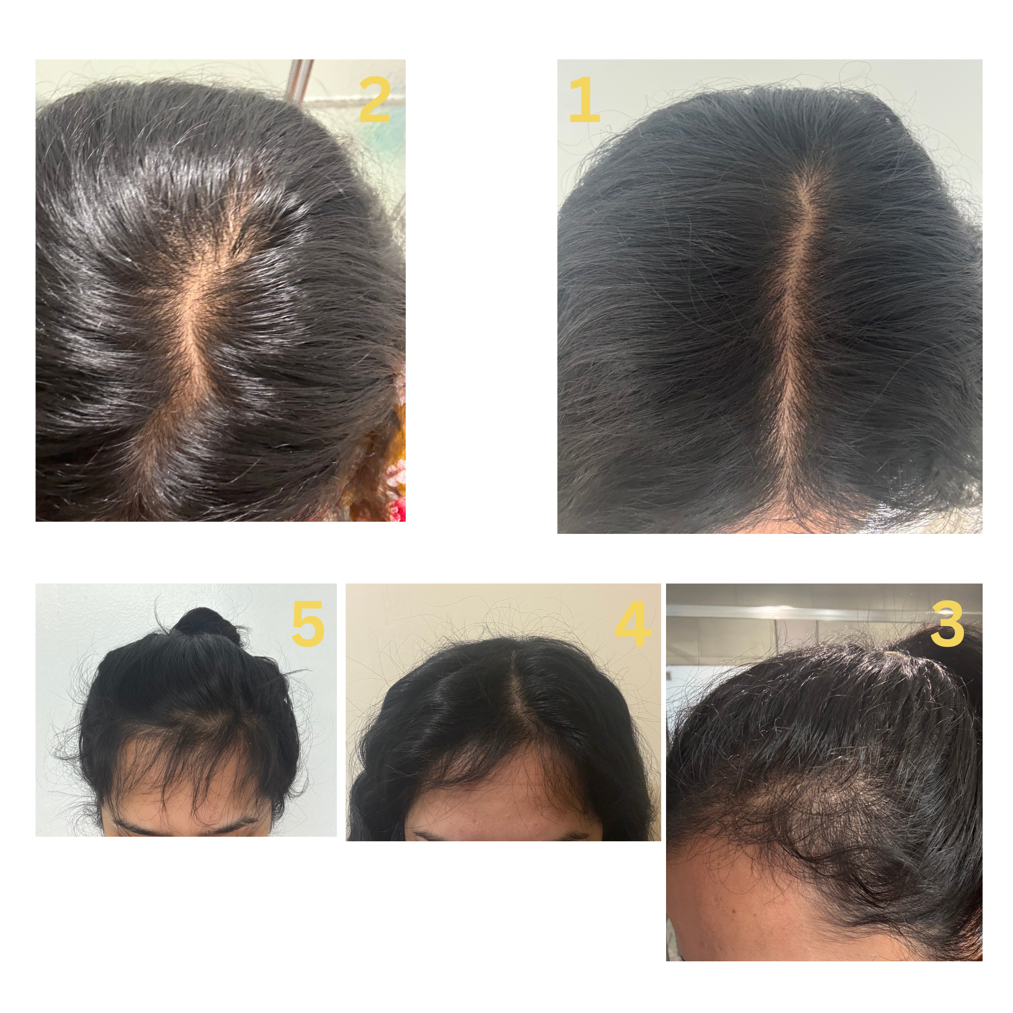 Collage of five images showing different views of a person's head with hairline issues.